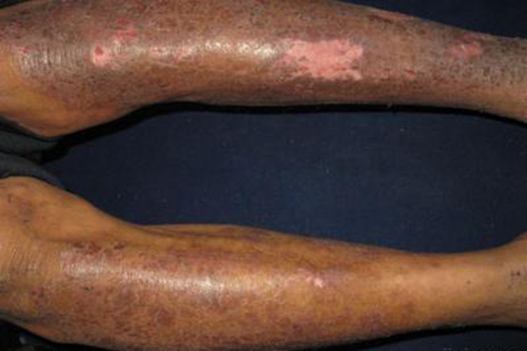 慢性湿疹小腿发黑图