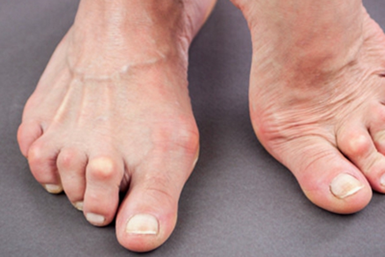 风湿热脚趾关节有黄豆样疙瘩图