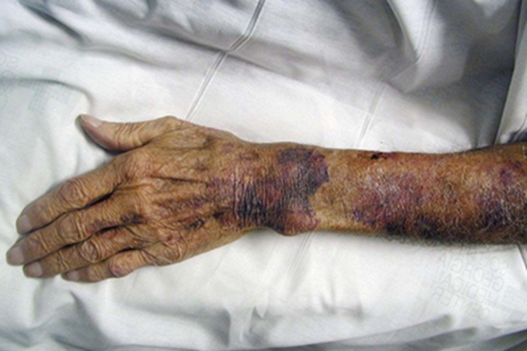 血小板增多性紫癜胳膊紫斑图