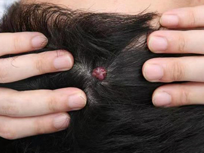 化脓性肉芽肿头皮上有肉粒图.jpg