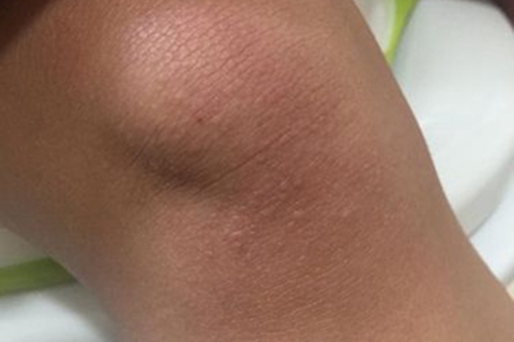 小儿丘疹性肢端皮炎膝盖小疙瘩图