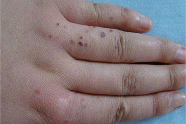 血管角化瘤手部症状图