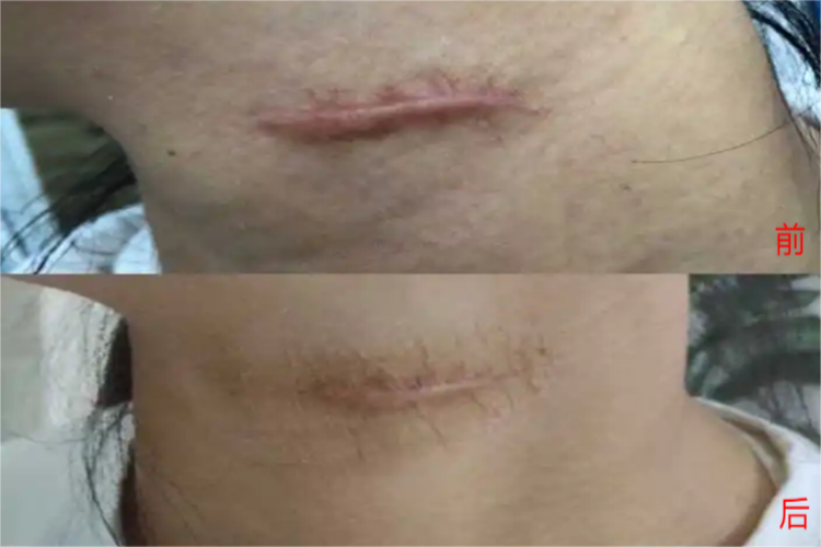 疤痕软化针前后对比图