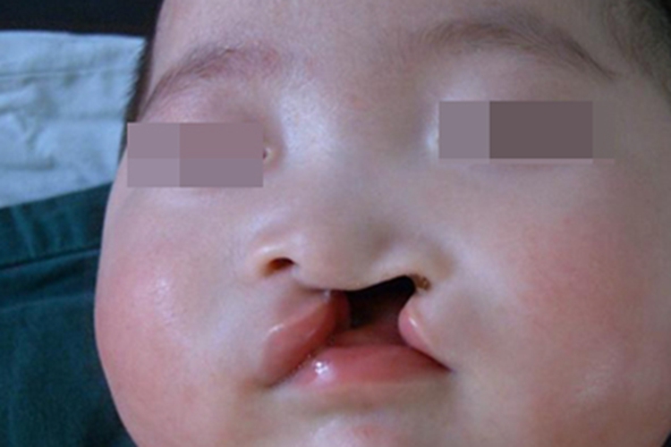 Ⅲ度唇裂嘴唇症状图 Ⅲ度唇裂嘴唇症状图