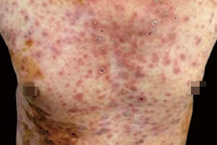 苔藓样糠疹胸部症状图