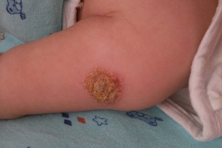 芽生菌病样脓皮病胳膊症状图