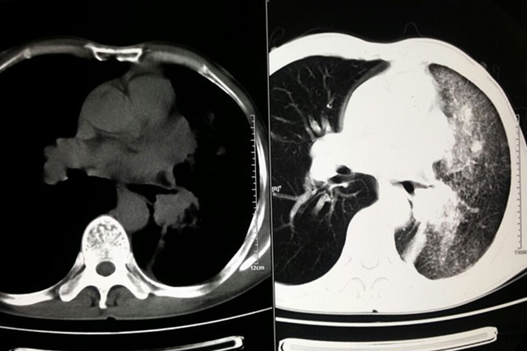 中央型肺癌CT图