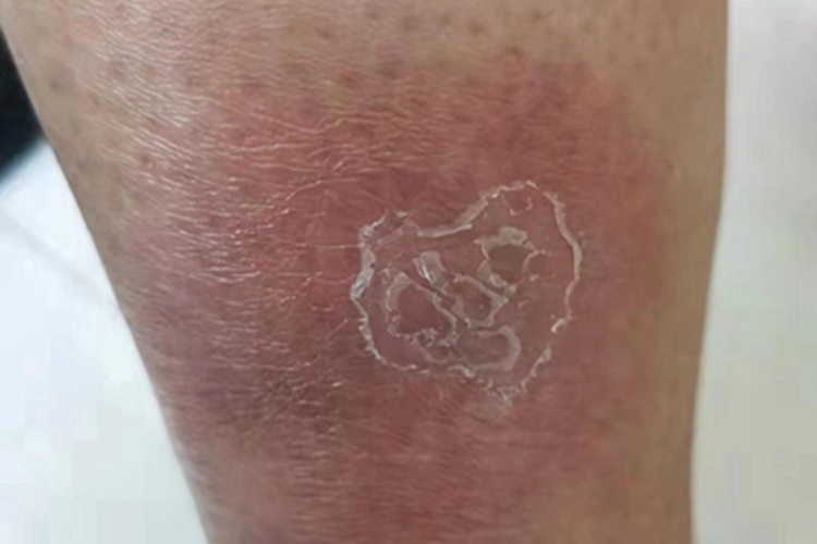 急性期硬化性脂膜炎脱皮图