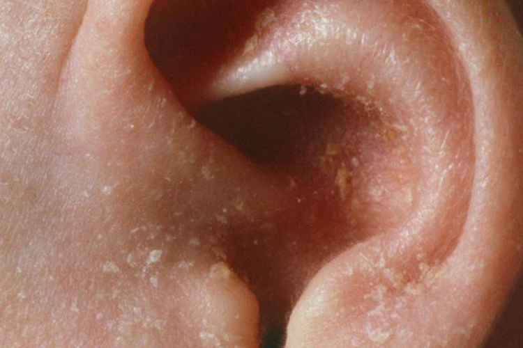 宝宝耳朵脱皮症状图片