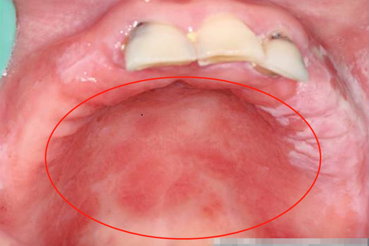 慢性红斑型念珠菌病图