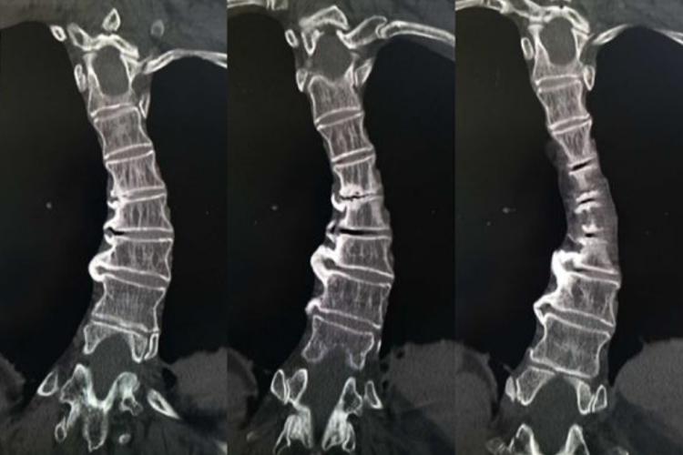 脊柱右侧弯CT图 脊柱右侧弯CT图