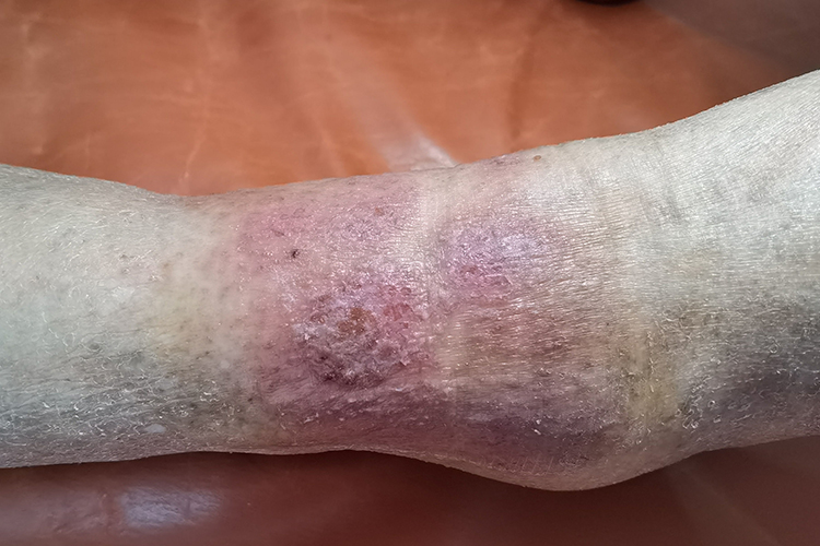 脚部急性湿疹图 脚部急性湿疹图