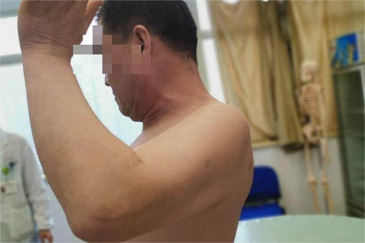 肩袖损伤外旋受限图 肩袖损伤外旋受限图