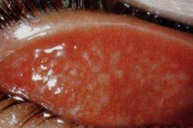 滤泡性结膜炎结膜充血疙瘩图 滤泡性结膜炎结膜充血疙瘩图