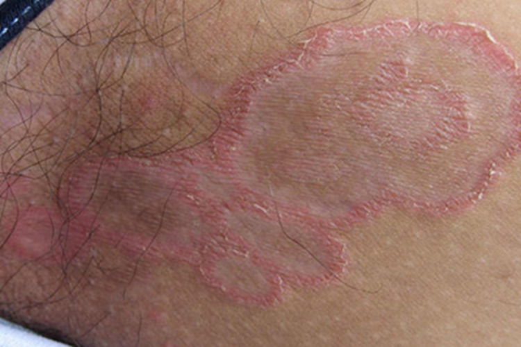 股癣大腿根内侧斑干燥脱屑图 股癣大腿根内侧斑干燥脱屑图