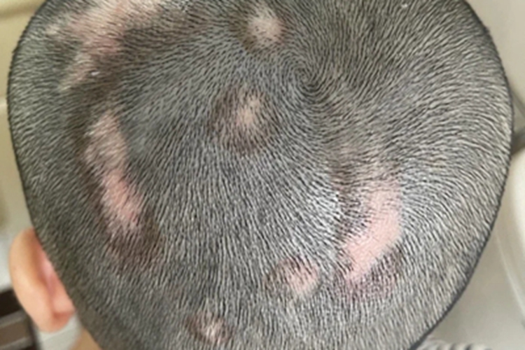 进展期节段型白癜风头部症状图 进展期节段型白癜风头部症状图