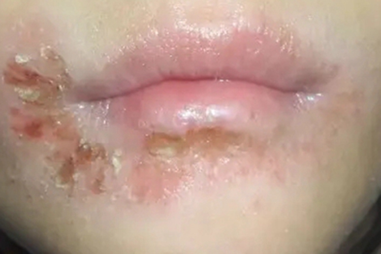 药物过敏性口炎口周结痂图