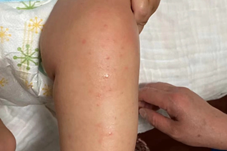 特应性皮炎大腿渗液图