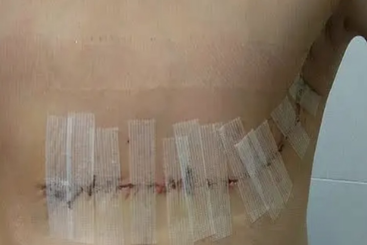 乳腺癌全切术后伤疤图