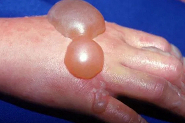 接触性皮炎手背大水疱图