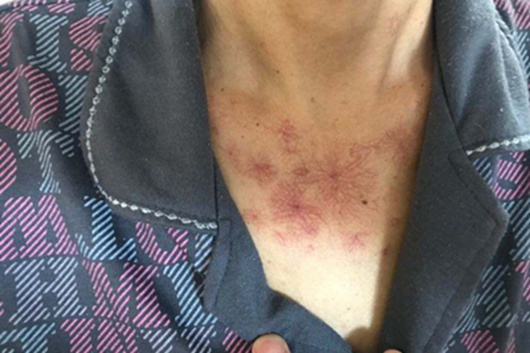 蜘蛛痣胸部症状图