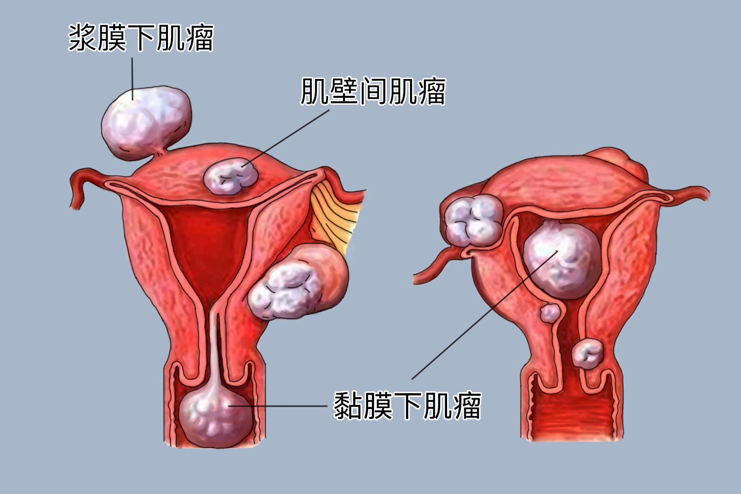 子宫肌瘤位置图