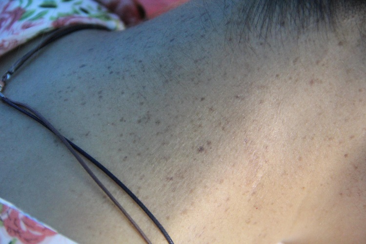 着色性干皮病后颈症状图