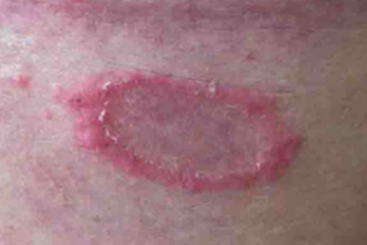 艾滋病初期皮肤玫瑰糠疹图