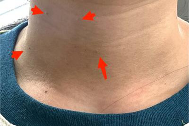 丝状疣颈部隆起的小疙瘩图