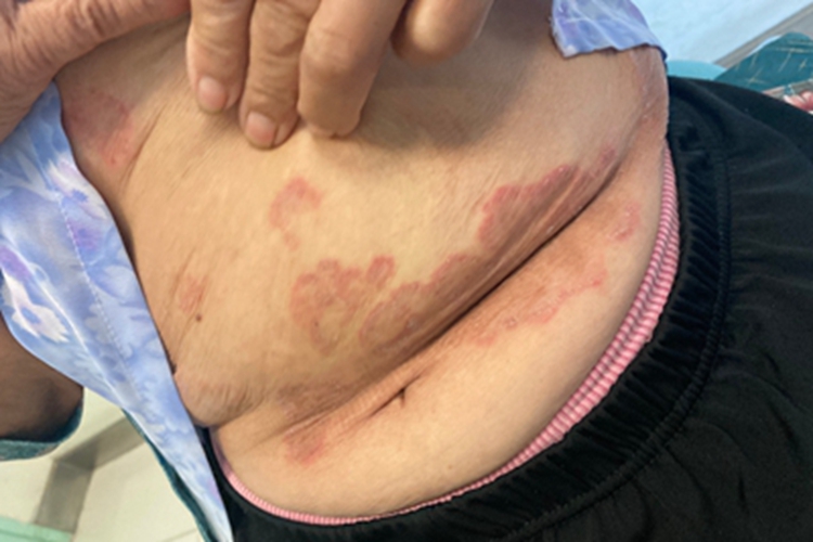 体癣腹部红斑斑块图 体癣腹部红斑斑块图