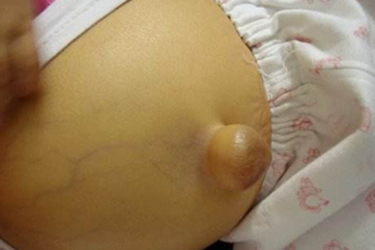 小儿脐疝肚脐鼓个包图 小儿脐疝肚脐鼓个包图