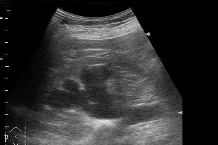 花朵样肾积水图