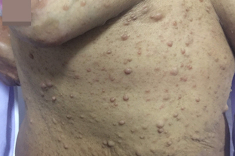 咖啡斑腹部长斑图