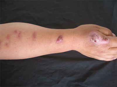 皮肤钙质沉着症的症状和图片 - 有来医生