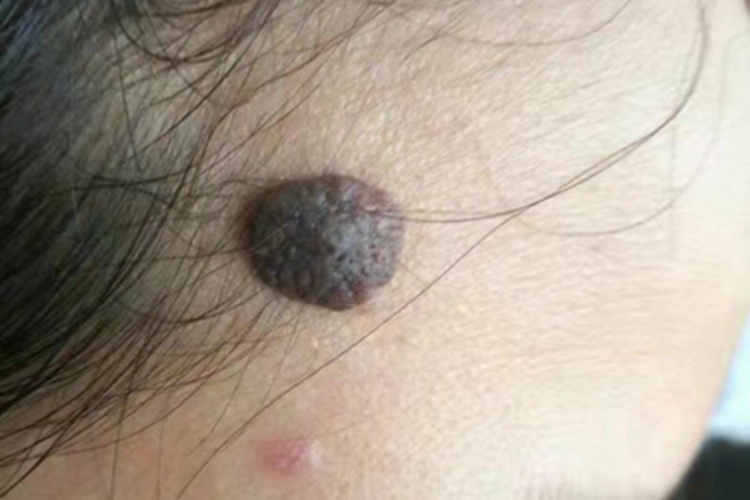 脂溢性角化病前额黑痣图