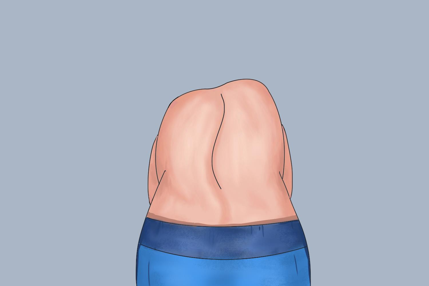 脊柱侧弯腰背部不对称图