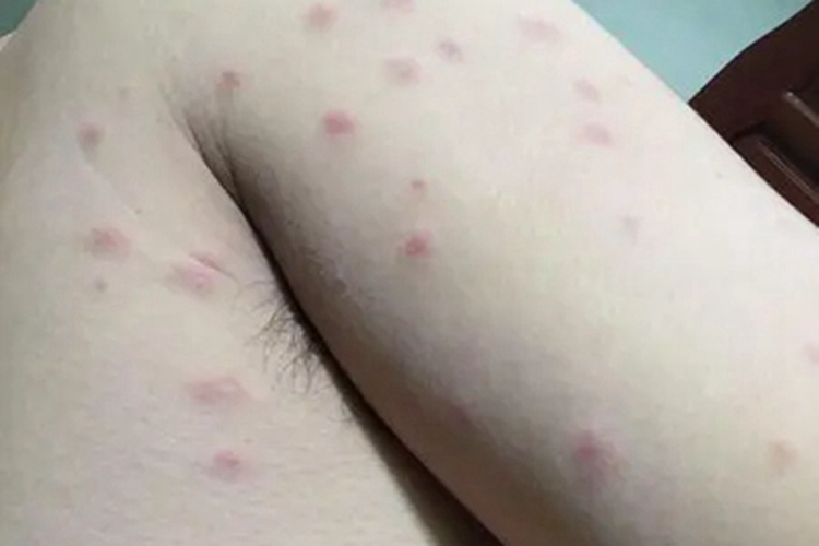 单纯性痒疹胳膊小疙瘩图
