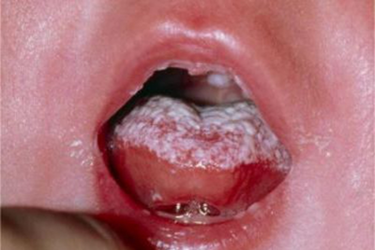 新生儿鹅口疮严重的症状图