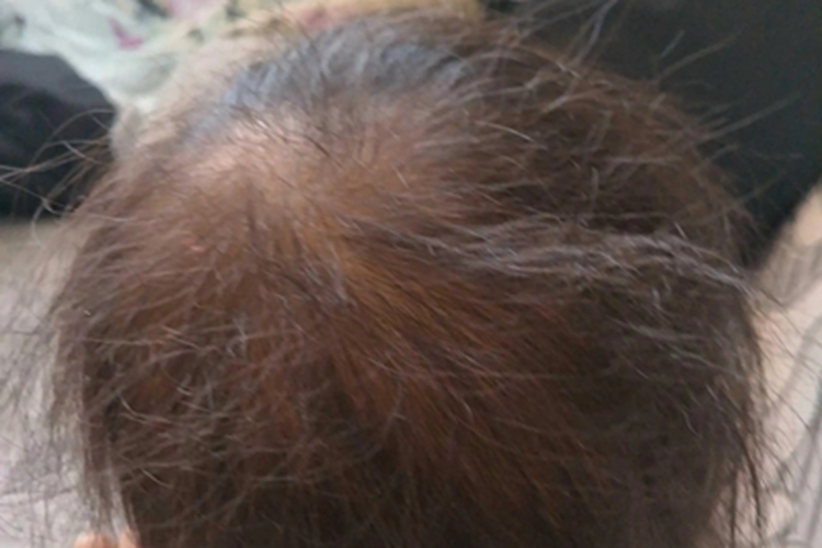 苯丙酮尿症头发棕黄色图