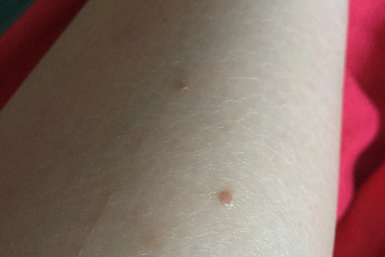 长在腿部的扁平疣图