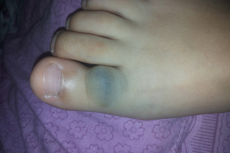 脚背的早期获得性簇状血管瘤图