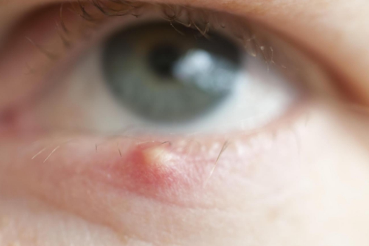 下眼皮睑腺炎图