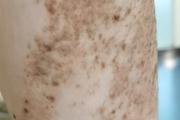 炎症型表皮痣小腿症状图