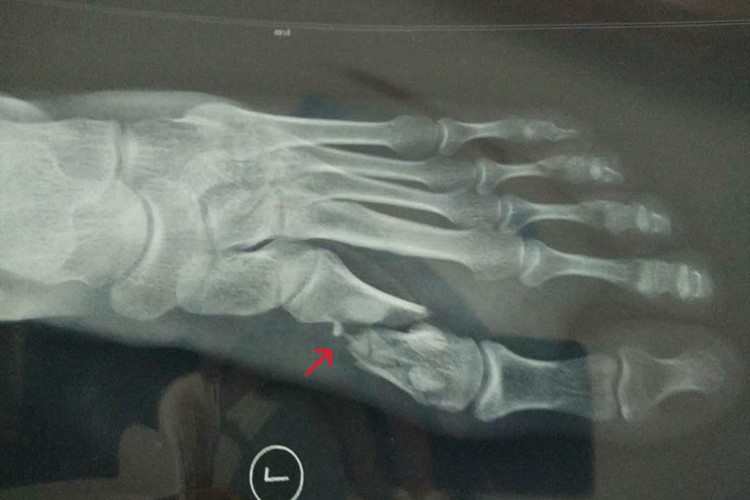 左足第一跖骨骨折影像图 左足第一跖骨骨折影像图