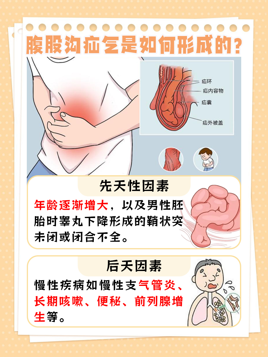 一文带你分析：腹股沟疝气是如何形成的？