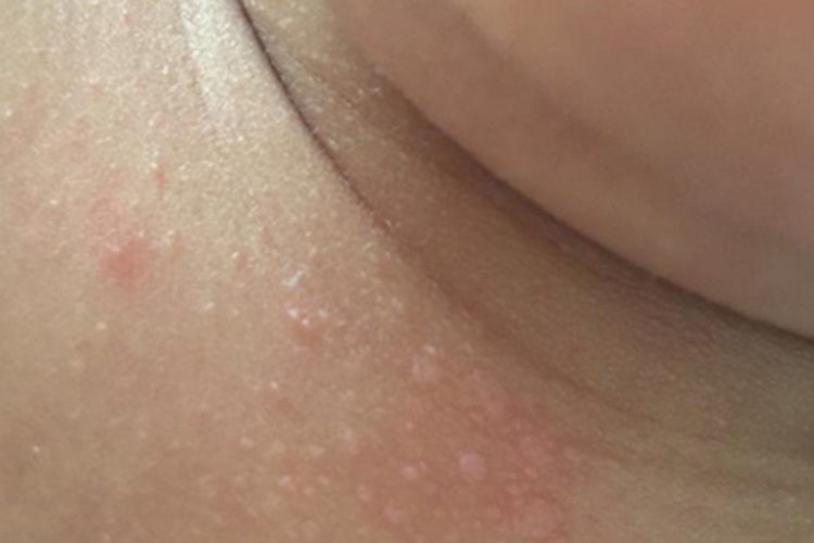 汗疱疹颈部症状图