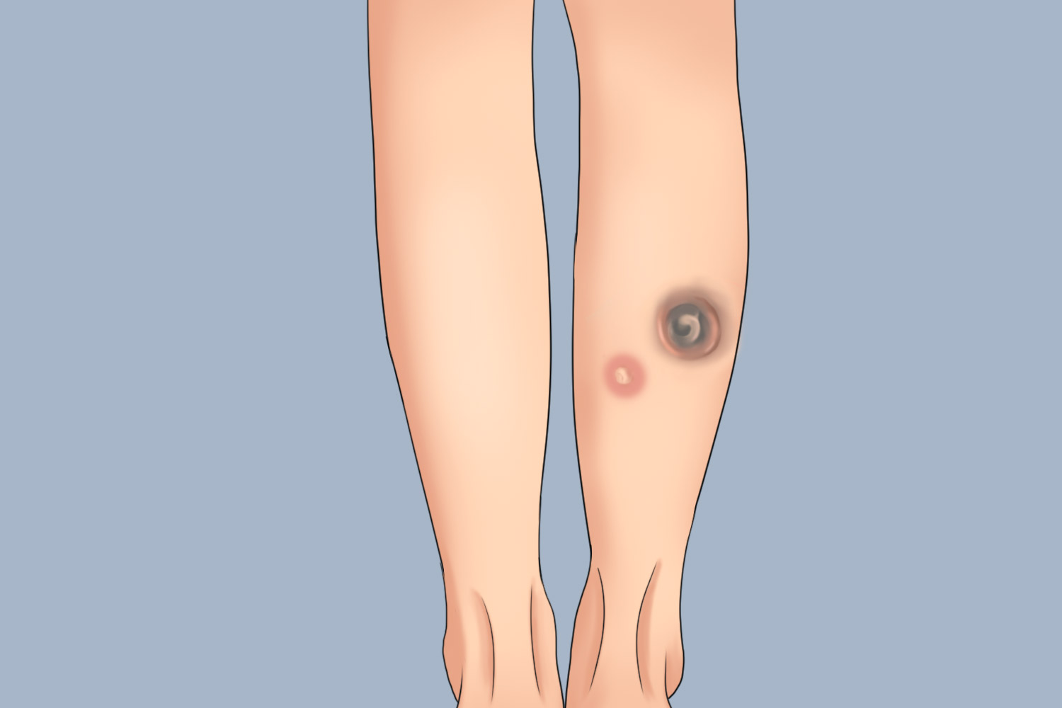 三期梅毒树胶肿图