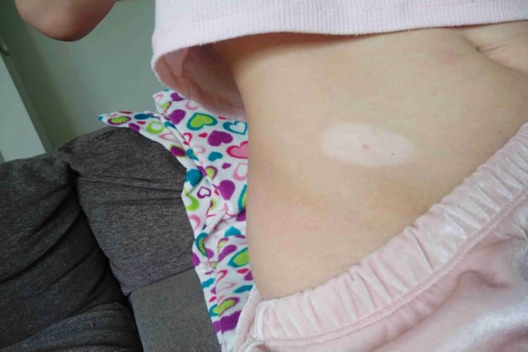 脱色素性痣腹部症状图