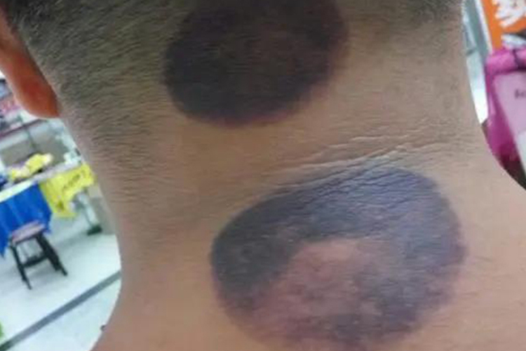 拔罐后皮肤暗红发紫图 拔罐后皮肤暗红发紫图