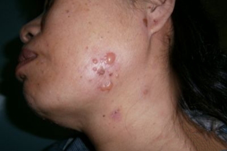 增殖型天疱疮面部症状图 增殖型天疱疮面部症状图